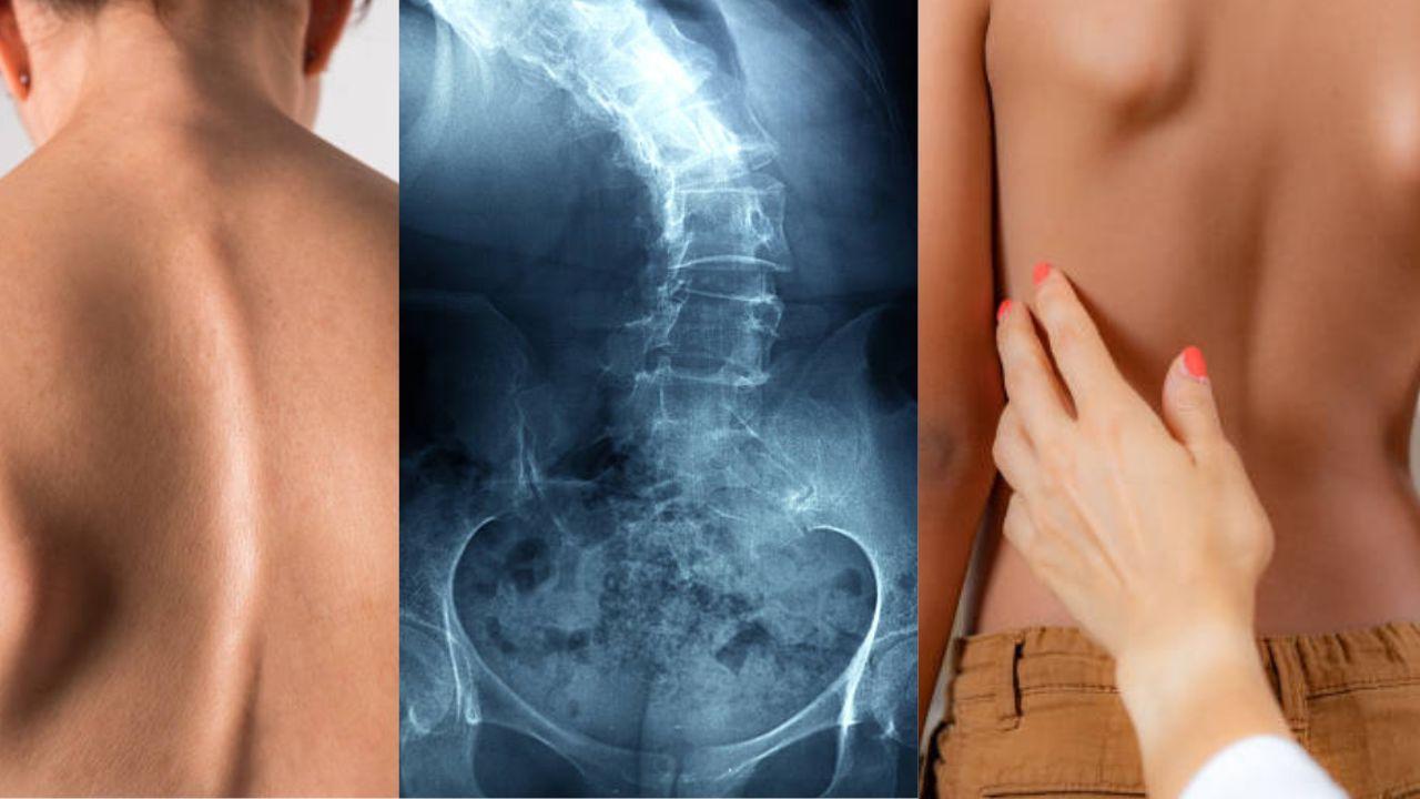 स्कोलियोसिस (Scoliosis)